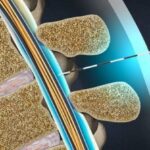 Epidural Steroid Injections acticle