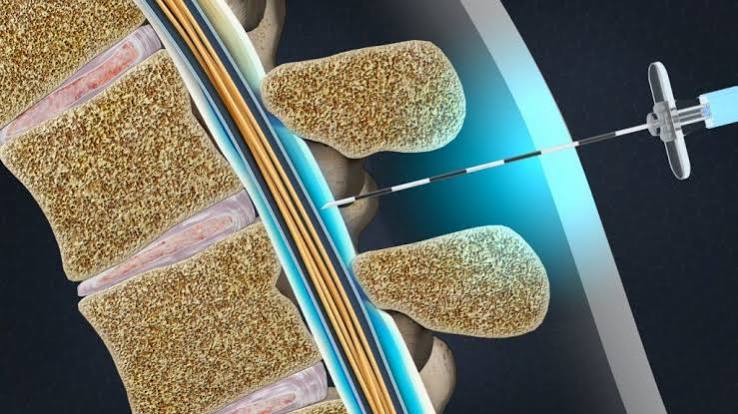 Epidural Steroid Injections acticle