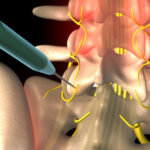 Radiofrequency Ablation