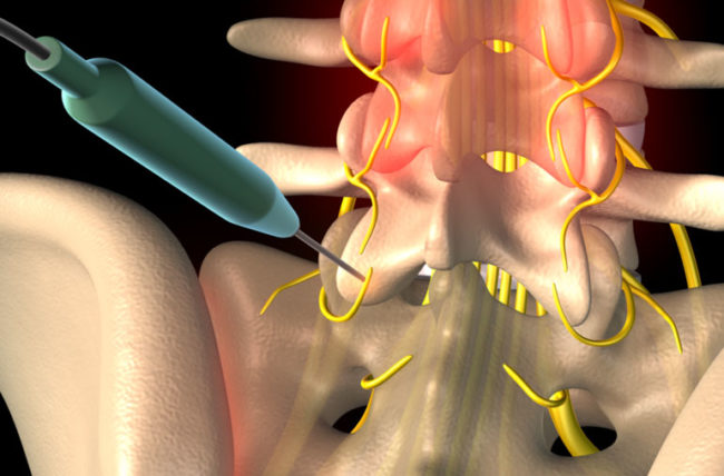 Radiofrequency Ablation